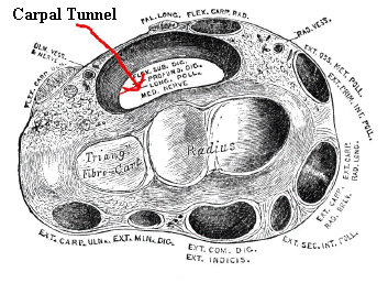 carpal tunnel syndrome : cross section