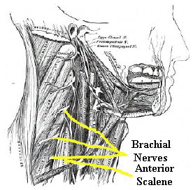 thoracic outlet syndrome : brachial nerves