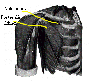 thoracic outlet syndrome : brachial impingement sites